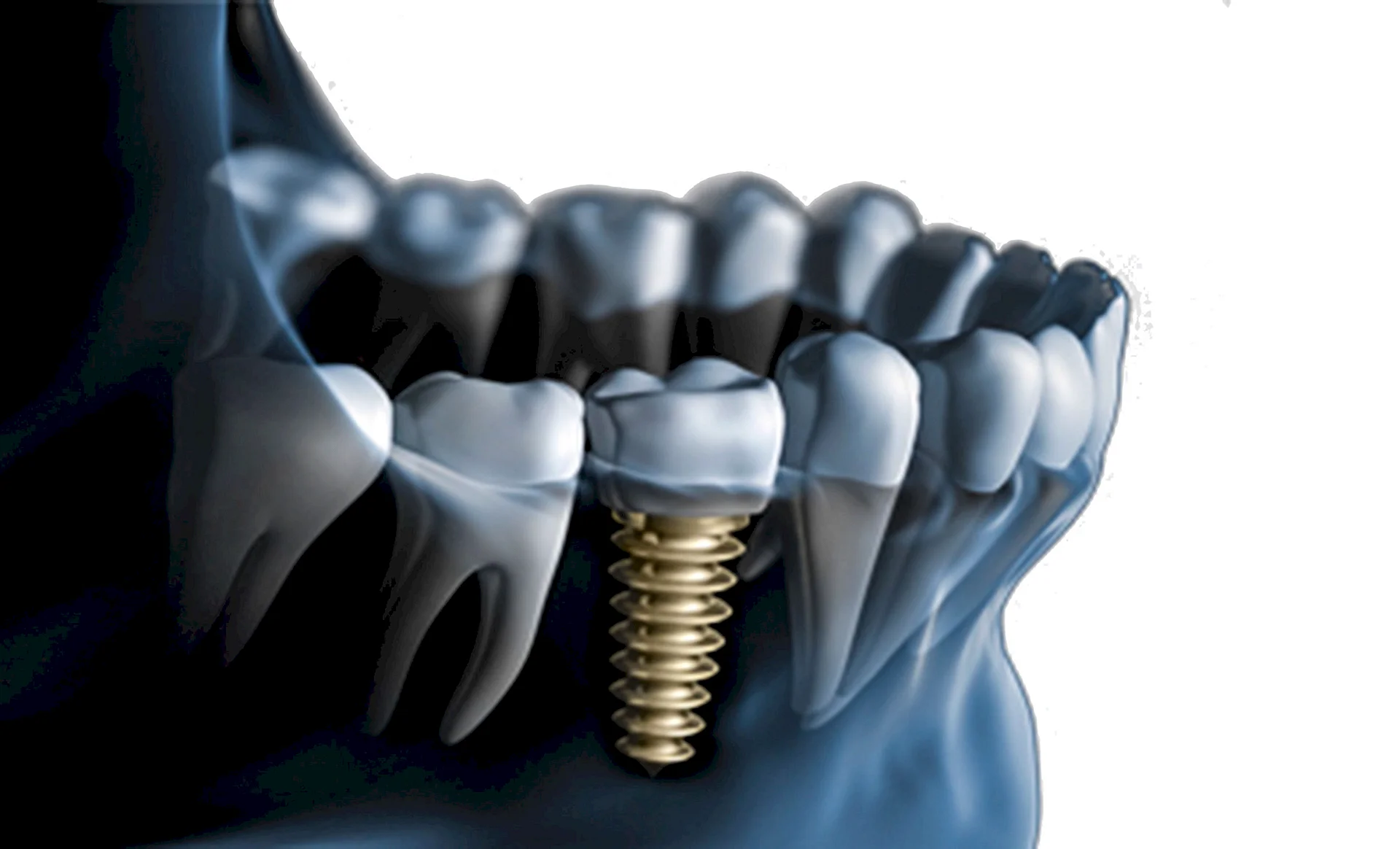 Gold Dental Implant Wallpaper